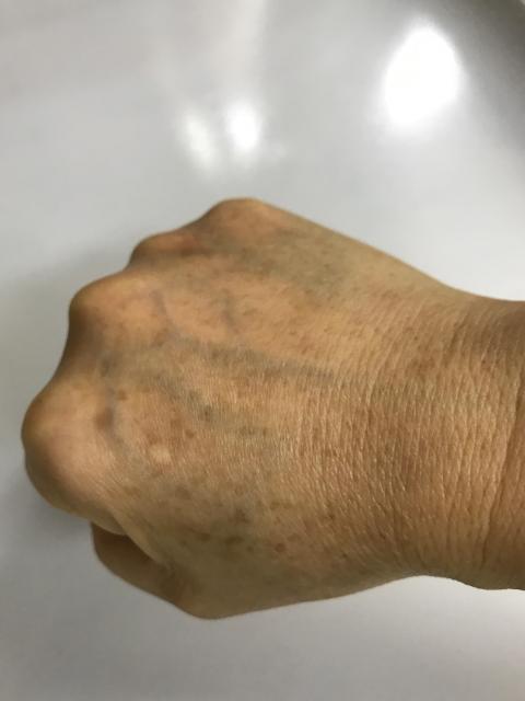 化了6千做手背激光去斑做了一年一粒斑都去唔到,去唔仲話我手果啲唔係斑真係無語,又叫我另外比錢做過其它療程,浪費時間與金錢。朋友請再三考慮…..