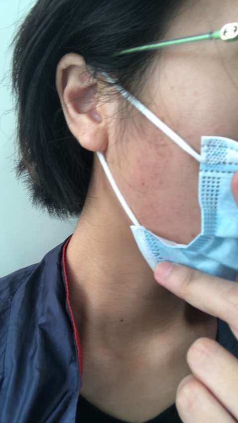 做完就过敏,生紅點又痕,仲要皮膚灼傷,自己諗