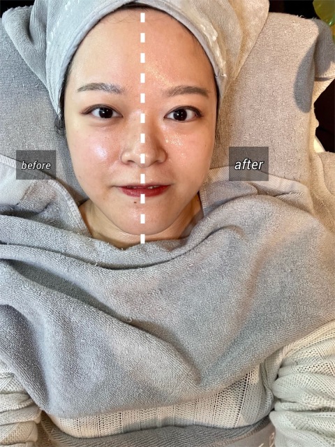 婚前補水! 因為要影pre-wedding想妝效好d, 朋友就介紹我去做"入秋補水2.0療程"。 環境舒適整潔,staff又貼心, 做treatment前解釋得好詳細,單次式收費,完全冇hard sell。
療程大約一個多小時, 做完導入part之後成個面都緊緻咗同去水腫。 最後就係最得意個part, 好似太空人蓋上太空罩等精華吸收就完成,短短一個鐘,皮膚由浮粉勁乾既狀態,變成嫩滑肌膚去黃效果一流!