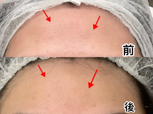 美容師,手勢好😍
真係必須要大讚,做完效果立即見到,我額頭紋即刻減淡咗❤️美容師仲俾咗前後相我留念🤣買咗幾次療程,期待日後再分享