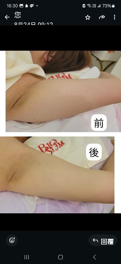 Masie首次到BioSlim體驗冰火溶脂立即瘦療程，好舒服凍凍地，今次做針對手臂，竟估不到做一次有這樣的效果，瘦左同無咁踵，治療師專嶪，顧問不硬銷，環境都乾淨，我會继續再做療程。