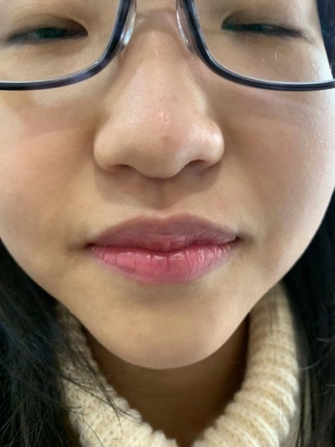 治療師好好會幫我影前後對比圖,然後send 俾我留記錄。激光脫完面膜真係好光滑皮膚顯得白淨左,上妝都貼咗好多,即時化妝已經感覺到。