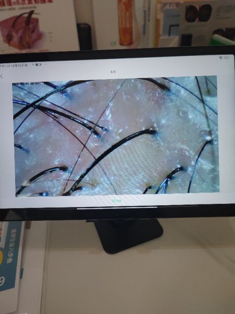 療程非常好,前後做用明顯見到頭皮冇咁油