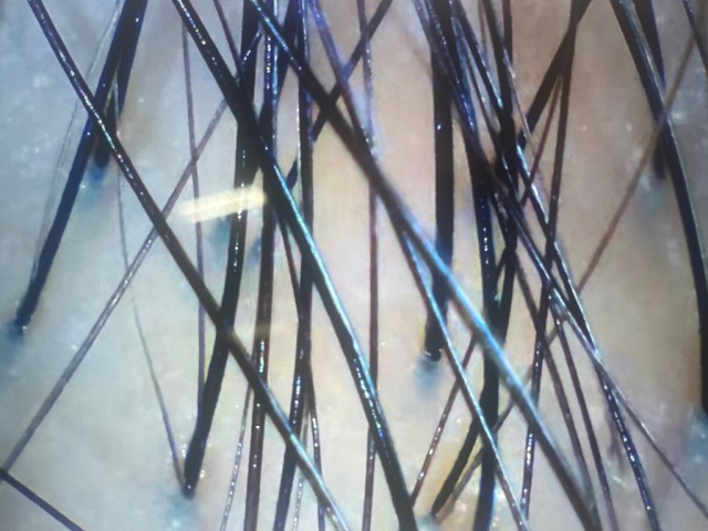 很好，會繼續去做，希望頭髮變得密。