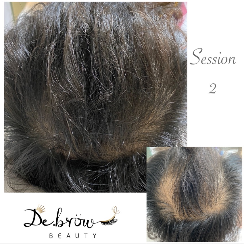 Scalp Micro pigmentation

📝利用微細點狀紋於頭皮上，仿製真毛囊的天然外觀，從而改善髮型外觀

🩺適合
脱髮 / 頭髮稀疏 /  手術疤痕修補 

📊療程效果一般可保持3至5年，要視乎個人新陳代謝及習慣而有所影