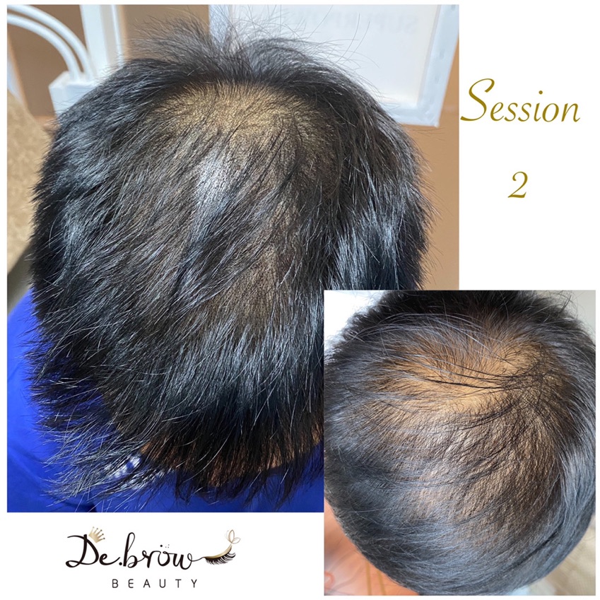 
Scalp Micro pigmentation

📝利用微細點狀紋於頭皮上，仿製真毛囊的天然外觀，從而改善髮型外觀

🩺適合
脱髮 / 頭髮稀疏 /  手術疤痕修補 

📊療程效果一般可保持3至5年，要視乎個人新陳代謝及習慣而有所影