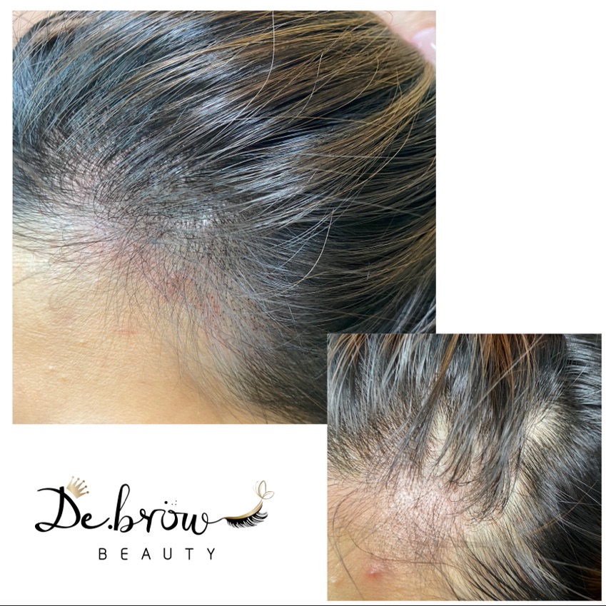 Scalp Micro pigmentation

📝利用微細點狀紋於頭皮上，仿製真毛囊的天然外觀，從而改善髮型外觀

🩺適合
脱髮 / 頭髮稀疏 /  手術疤痕修補 

📊療程效果一般可保持3至5年，要視乎個人新陳代謝及習慣而有所影