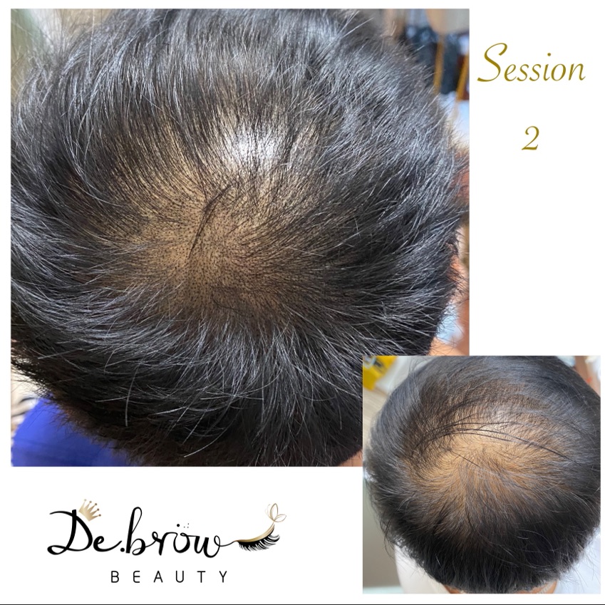 Scalp Micro pigmentation

📝利用微細點狀紋於頭皮上，仿製真毛囊的天然外觀，從而改善髮型外觀

🩺適合
脱髮 / 頭髮稀疏 /  手術疤痕修補 

📊療程效果一般可保持3至5年，要視乎個人新陳代謝及習慣而有所影