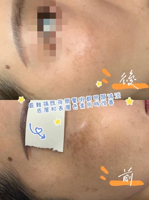 Pico祛斑療程