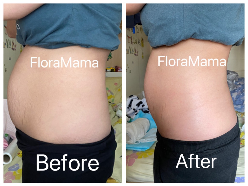 兩胎媽媽產後紥肚療程後～腹直肌分離改善咗，成個人都薄咗