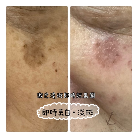 皮秒激光即時效果