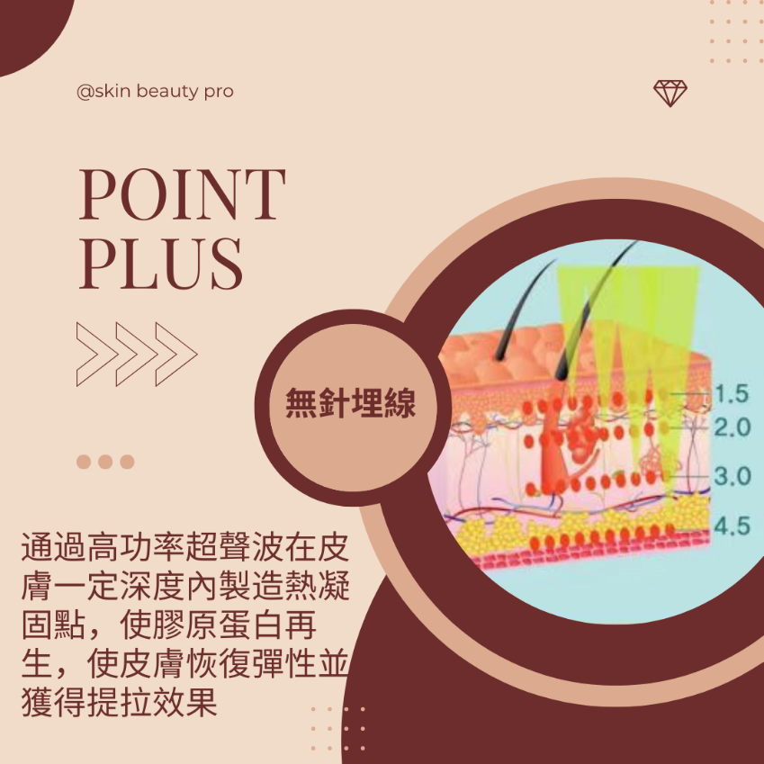 Point plus - 無針埋線