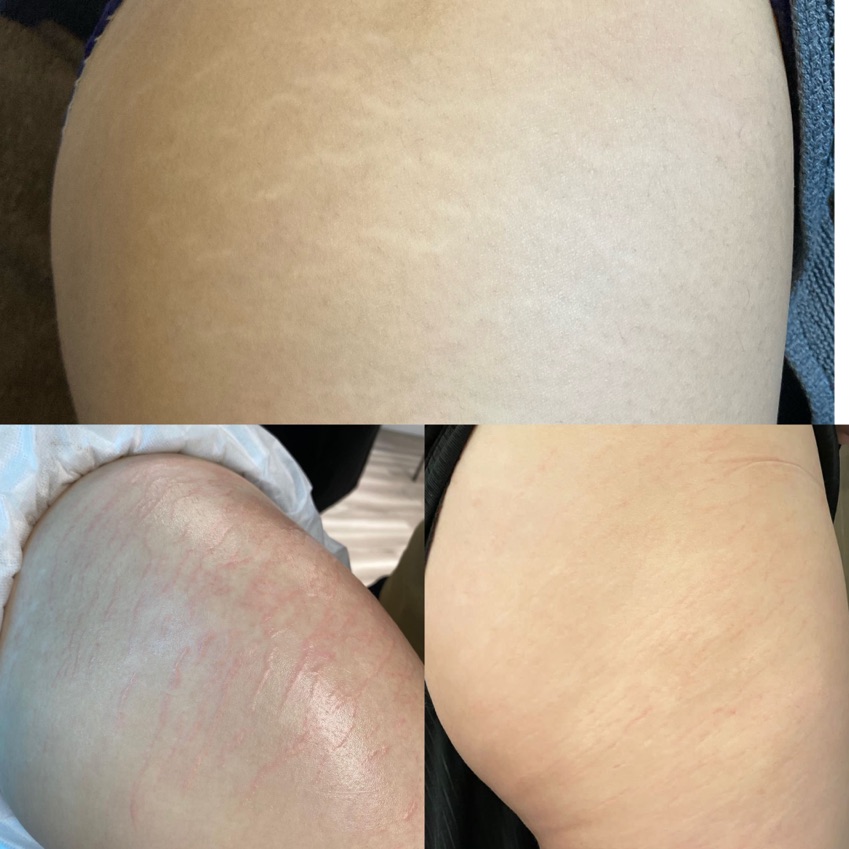 Skin52半永久覆蓋術：疤痕，￼妊娠紋，擴張紋