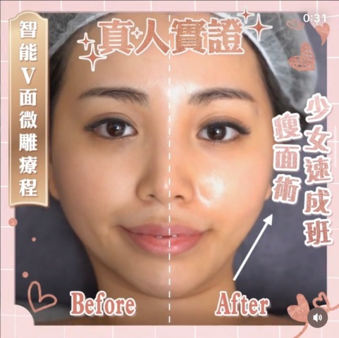 去面水腫微雕面部輪廓V面療程