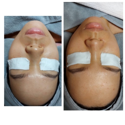 V Life 小顏面收緊膠原再生$980