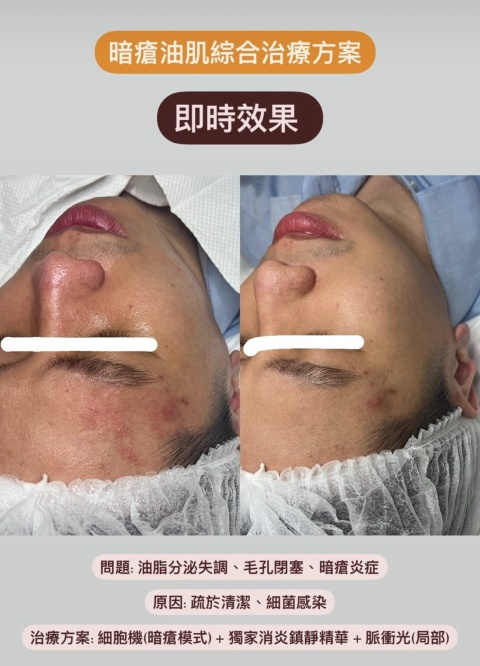 Magic peel 毛囊深層潔淨