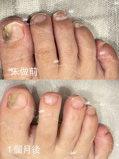 激走灰甲療程