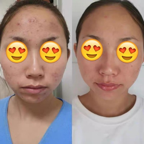 滑嘟嘟陶瓷肌 面部極速去印煥膚