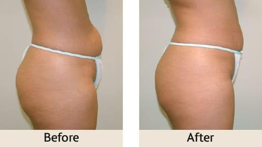 VELASHAPE 減脂瘦身療程