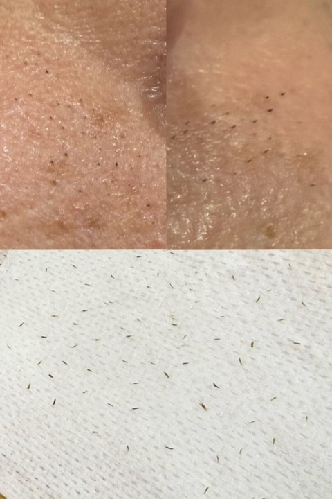 Aqua Peel 男士深層清潔面部療程