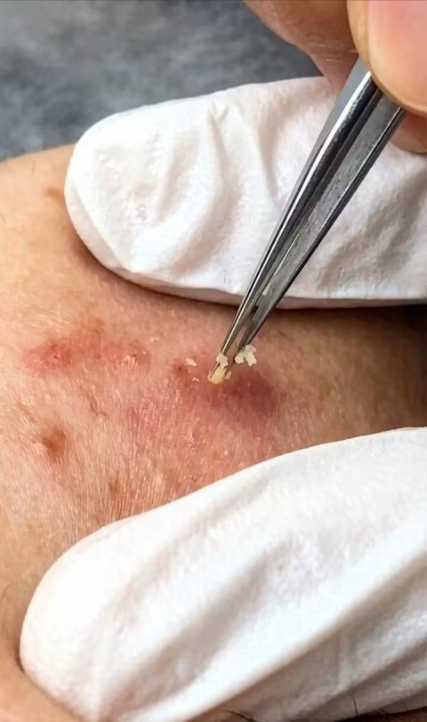 細胞鉗清療程