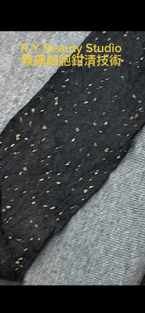 細胞鉗清療程